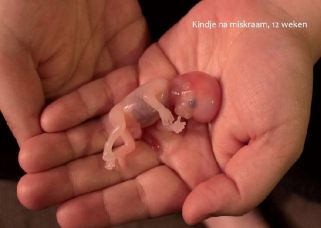 Miscarried Fetus at 8 Weeks